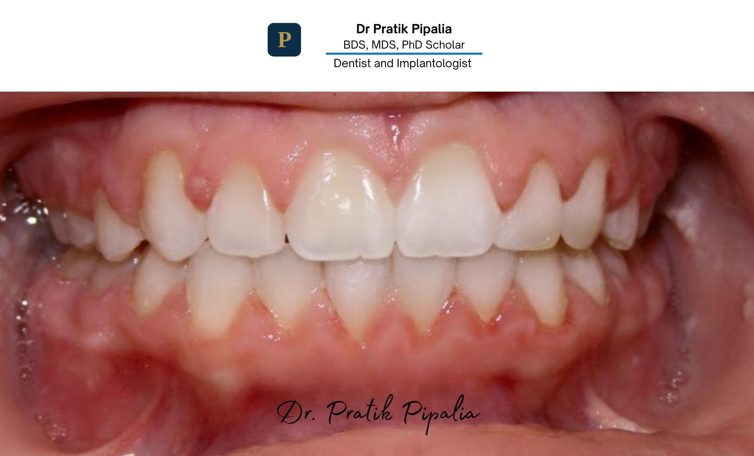 After dental implant treatment in Rajkot — natural smile result