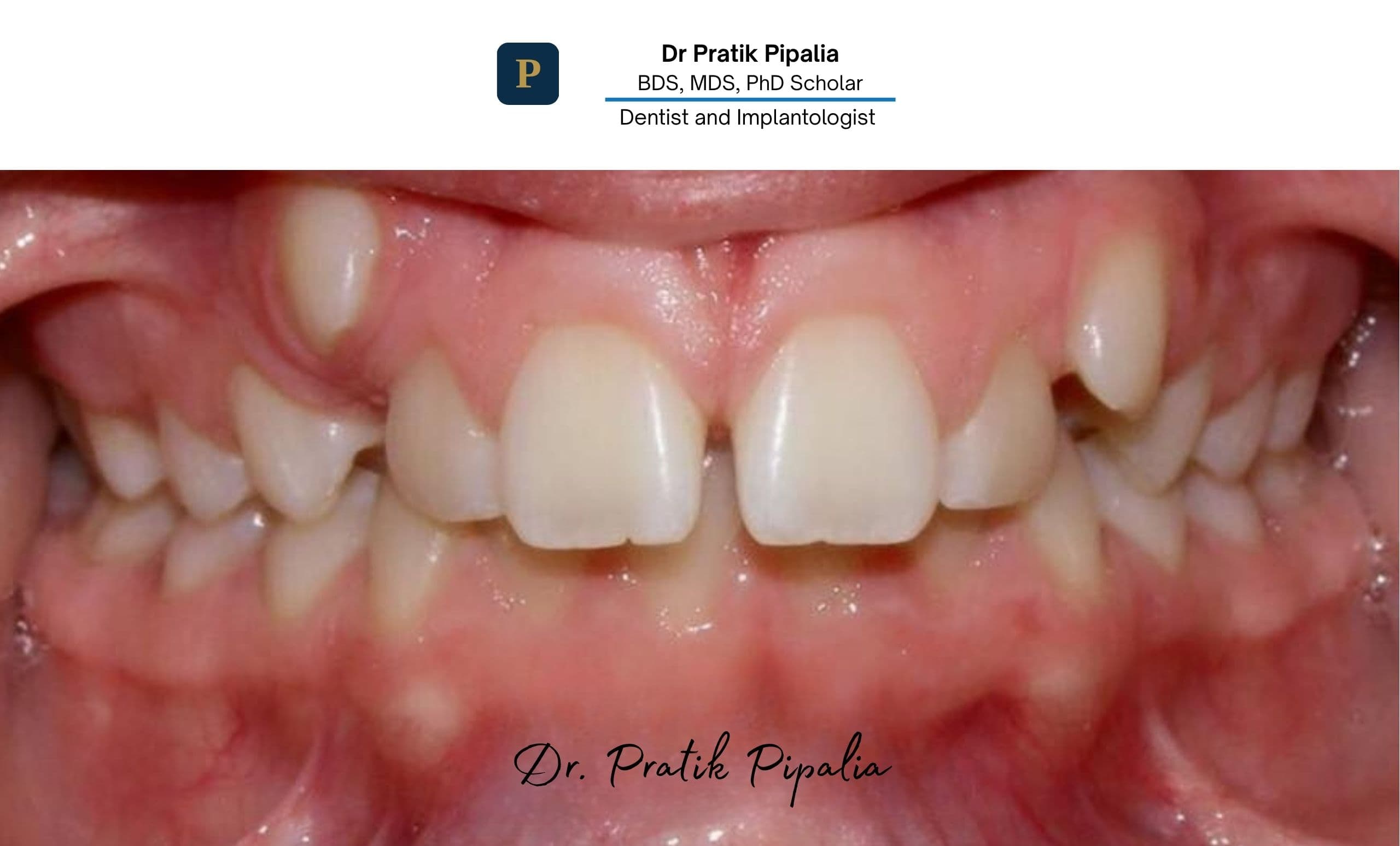 Before dental implant treatment in Rajkot
