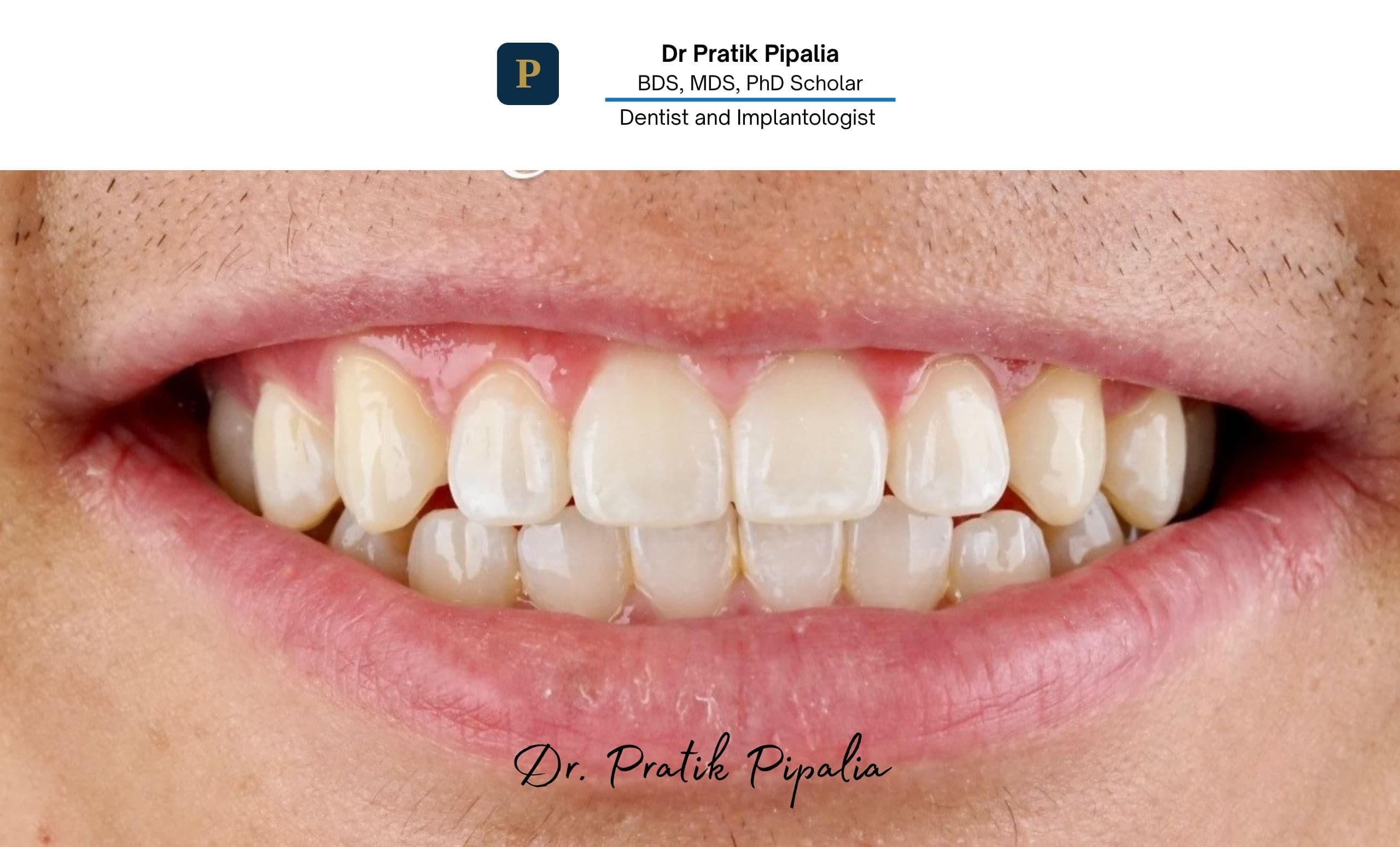 After full mouth rehabilitation in Rajkot