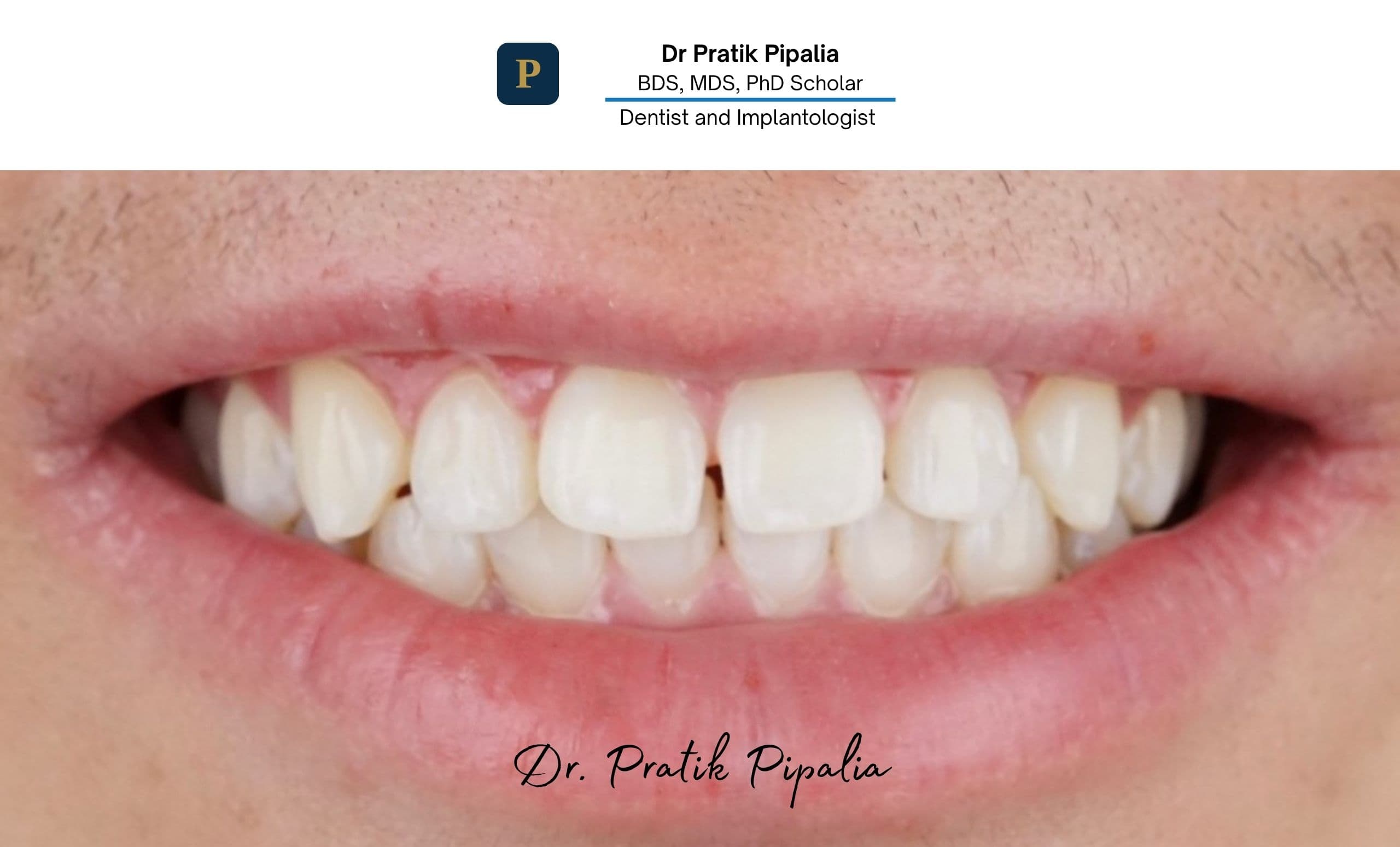 Before full mouth rehabilitation