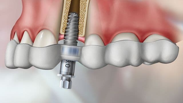 Guided Implant Surgery — advanced dental technology Rajkot
