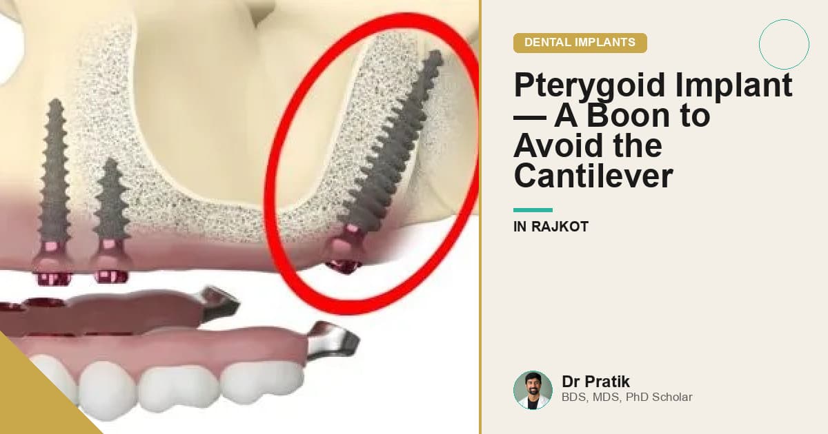Pterygoid Implant — A Boon to Avoid the Cantilever
