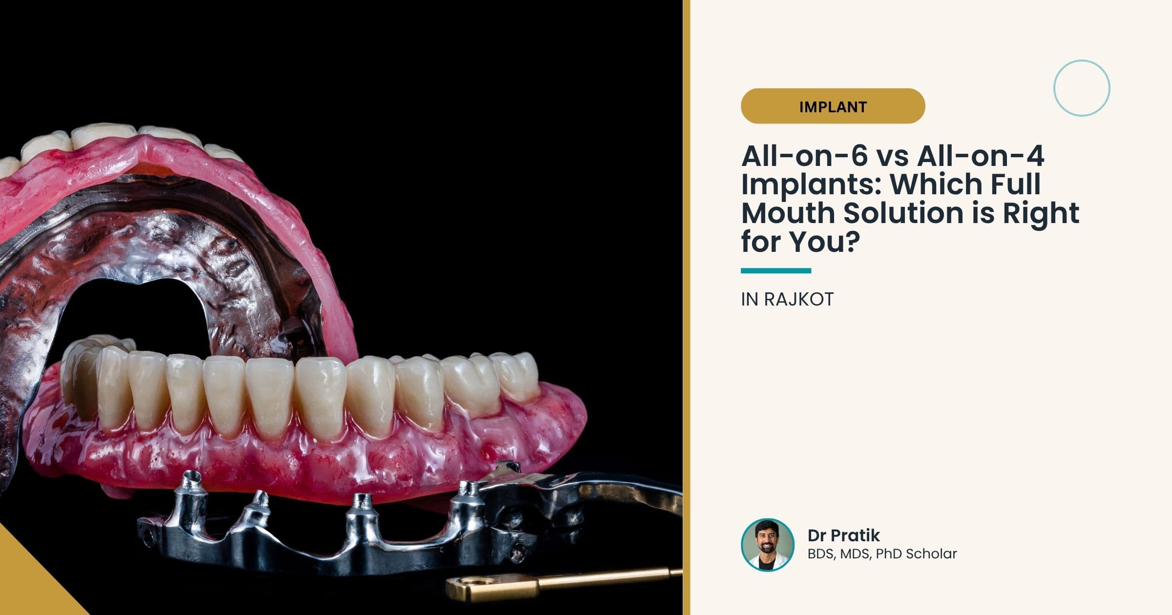 All-on-6 vs All-on-4 Implants: Which Full Mouth Solution is Right for You?