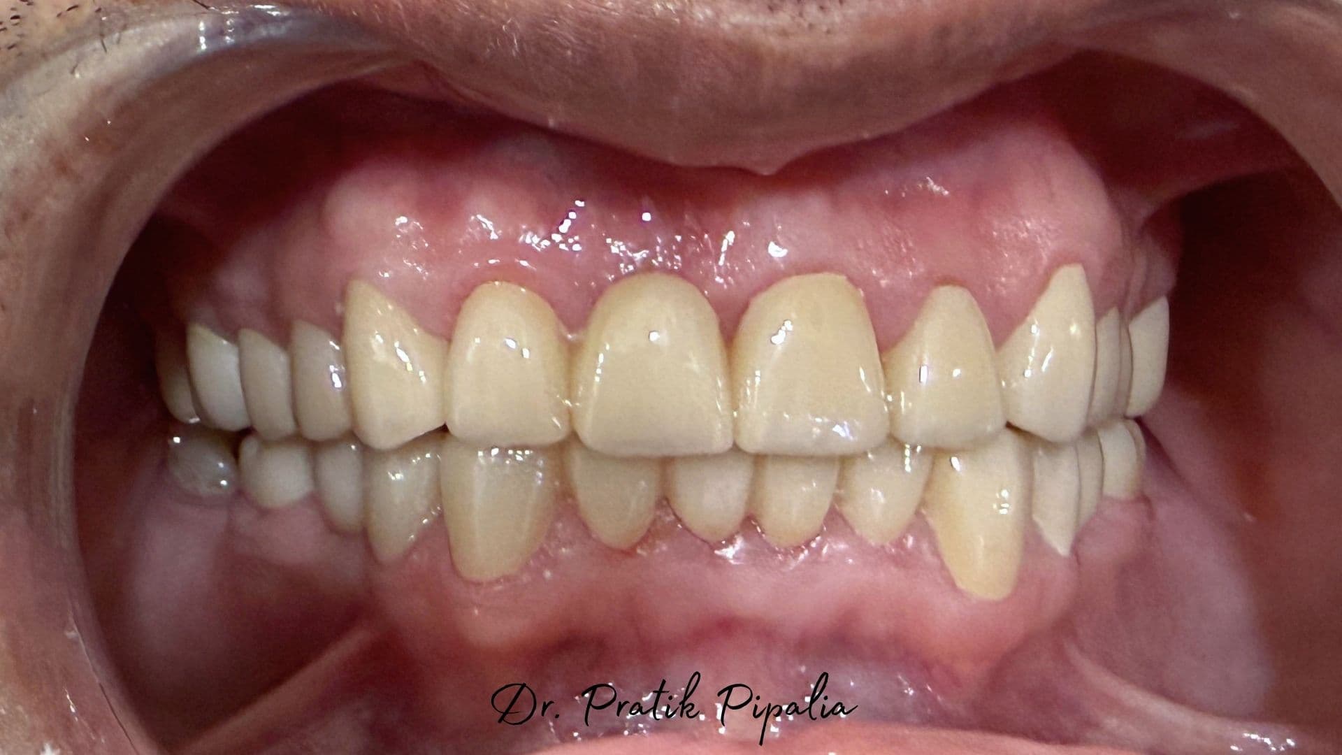 Jayeshbhai S after full mouth rehabilitation in Rajkot — US dental tourism patient
