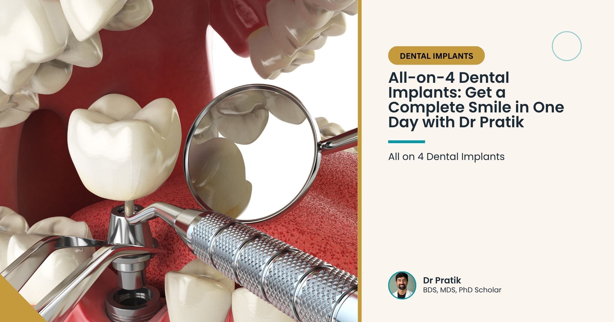 All-on-4 Dental Implants: Get a Complete Smile in One Day with Dr Pratik