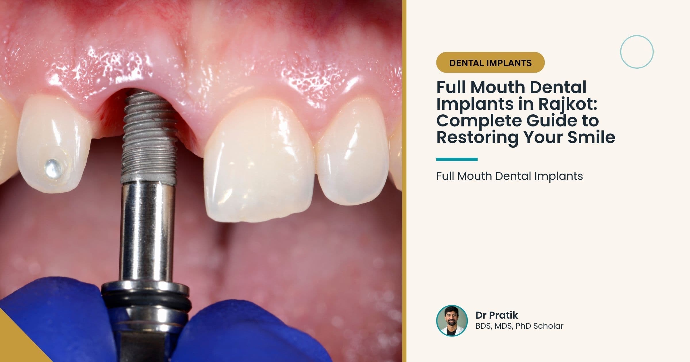 Full Mouth Dental Implants in Rajkot: Complete Guide to Restoring Your Smile