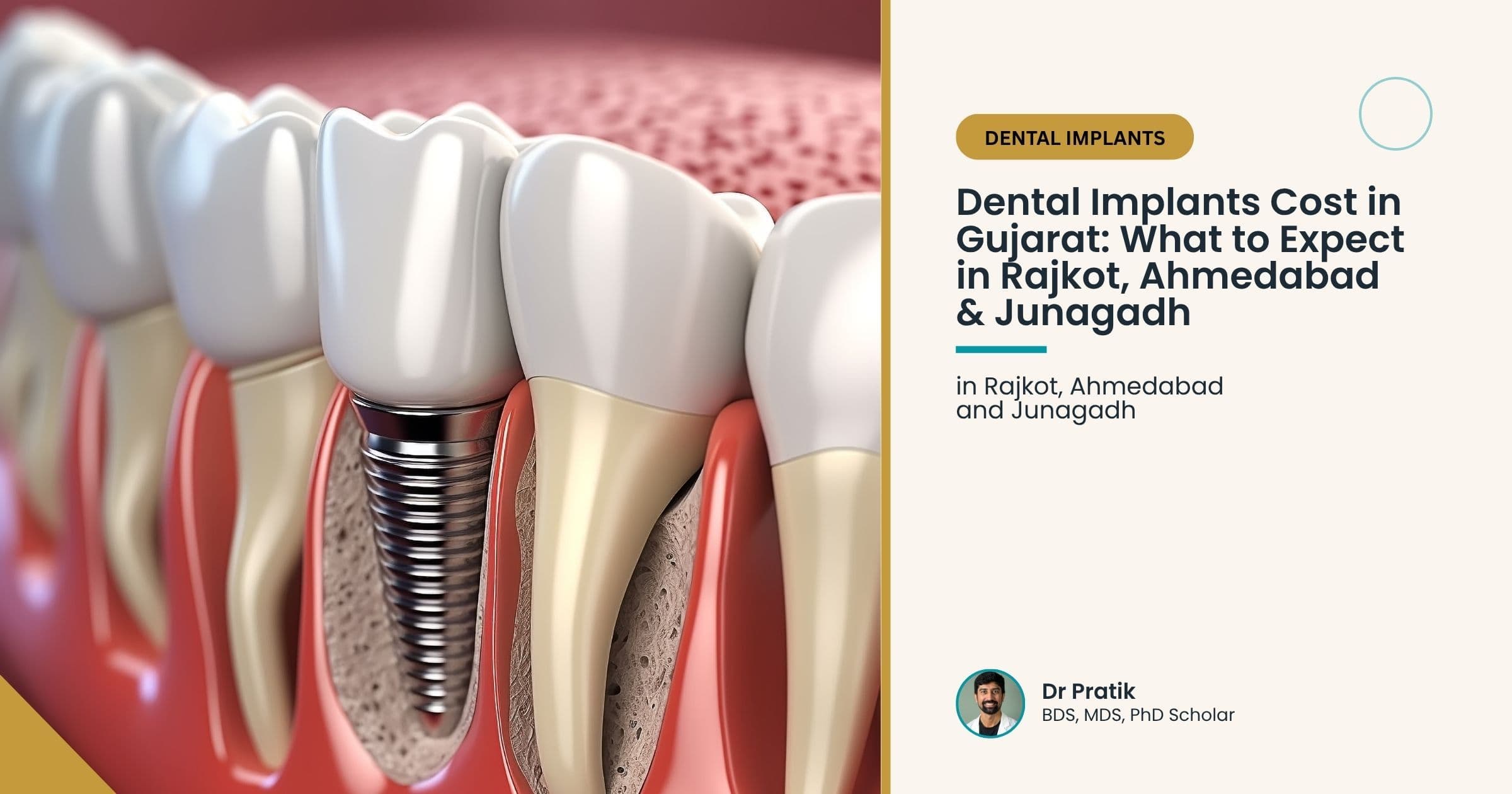 Dental Implants Cost in Gujarat: What to Expect in Rajkot, Ahmedabad & Junagadh